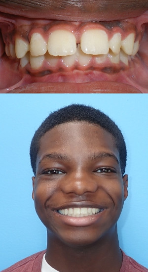 orthodontic faqs